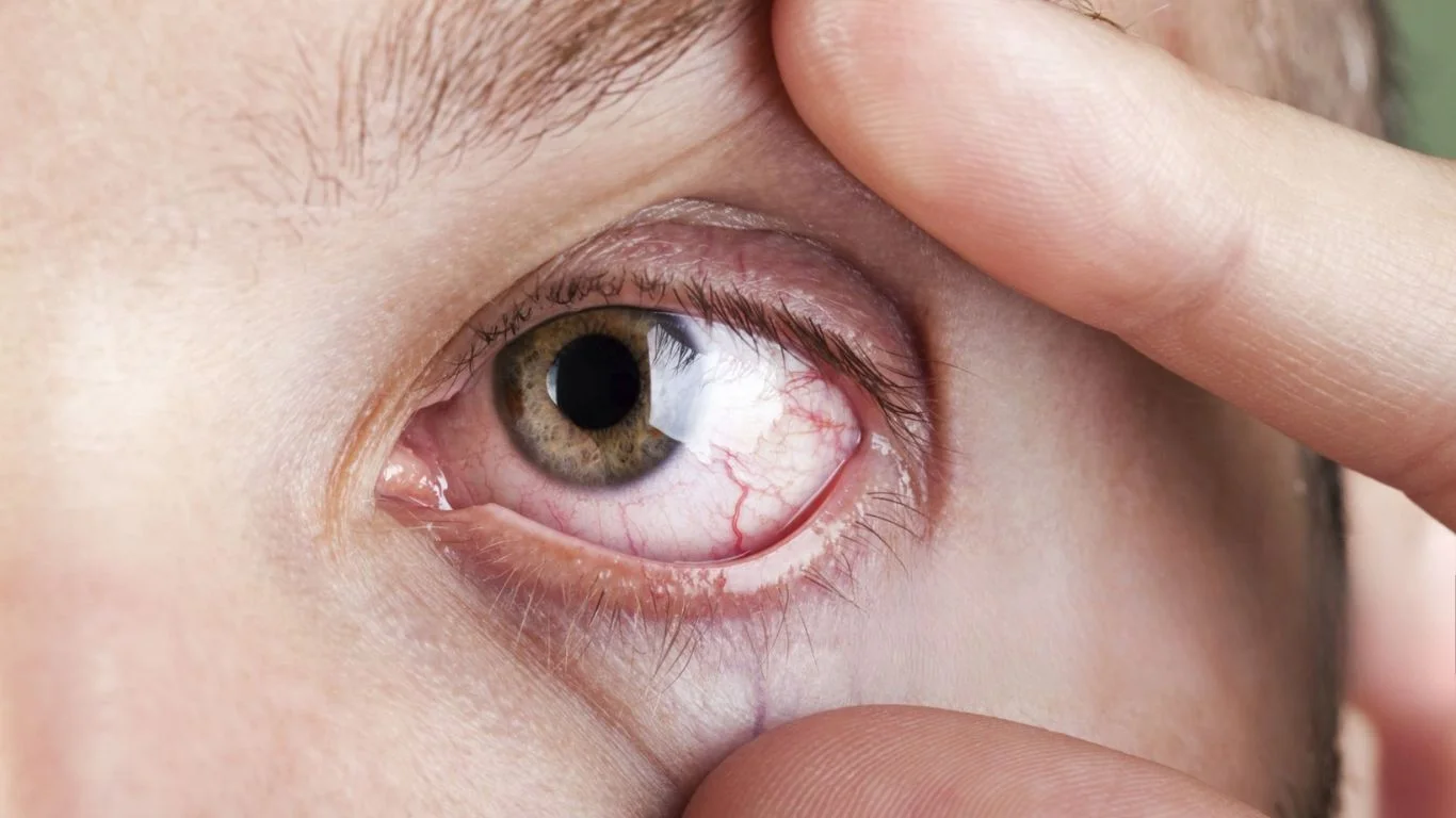 Dry Eye Syndrome