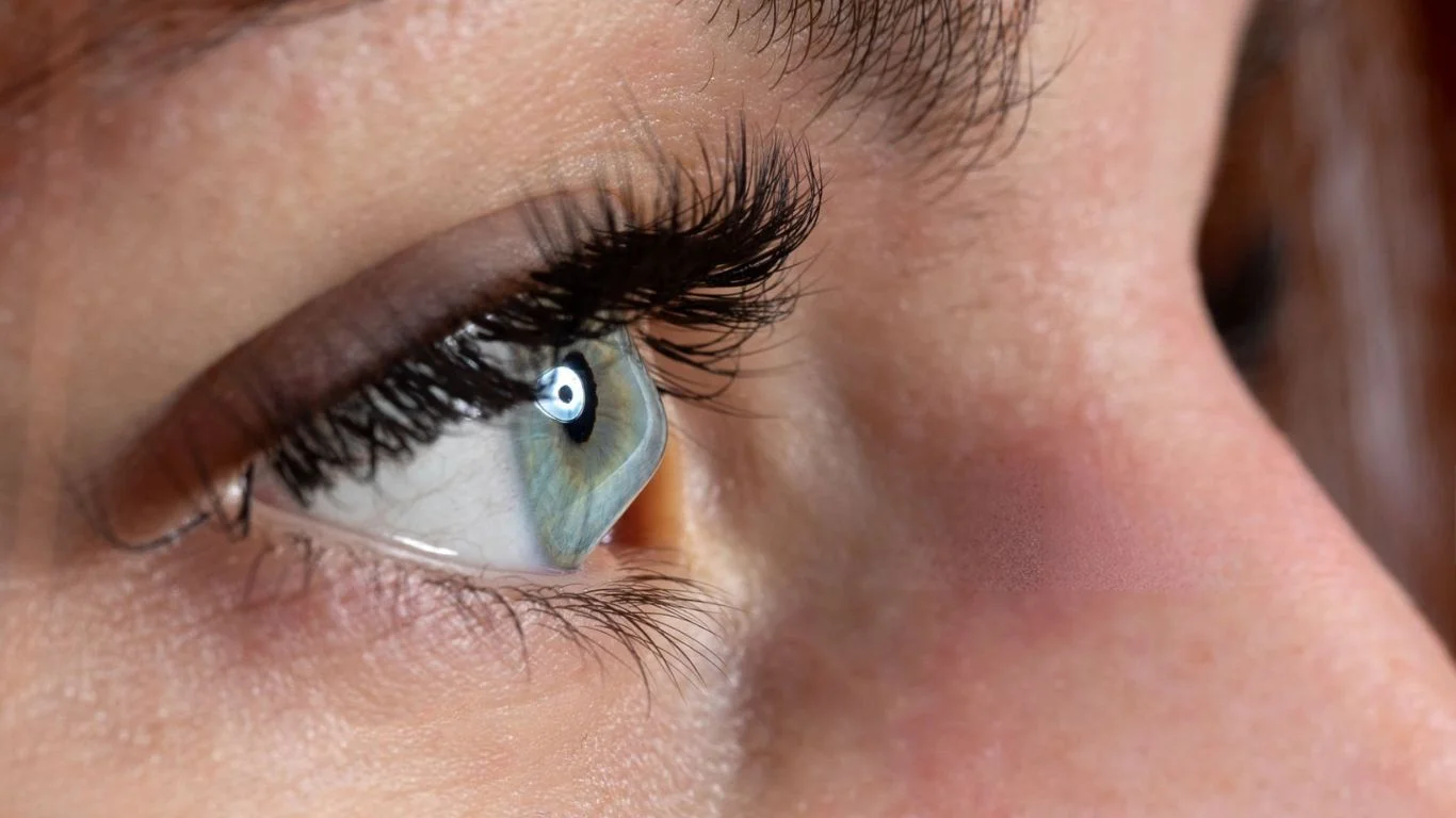Keratoconus