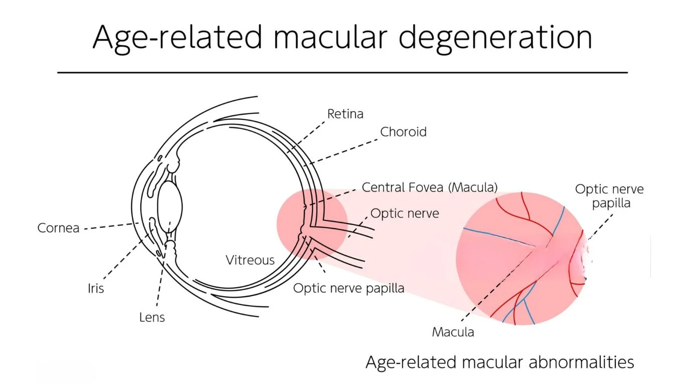 Macular Degeneration Treatment
