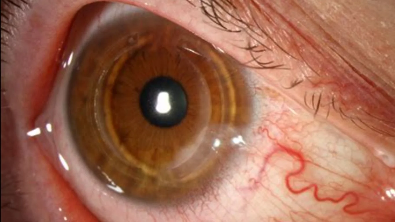 Intacs Corneal Rings
